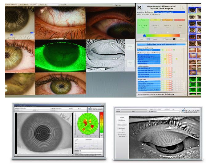 eyelids,eyelash meibography of the bottom and top eyelids corneal topography