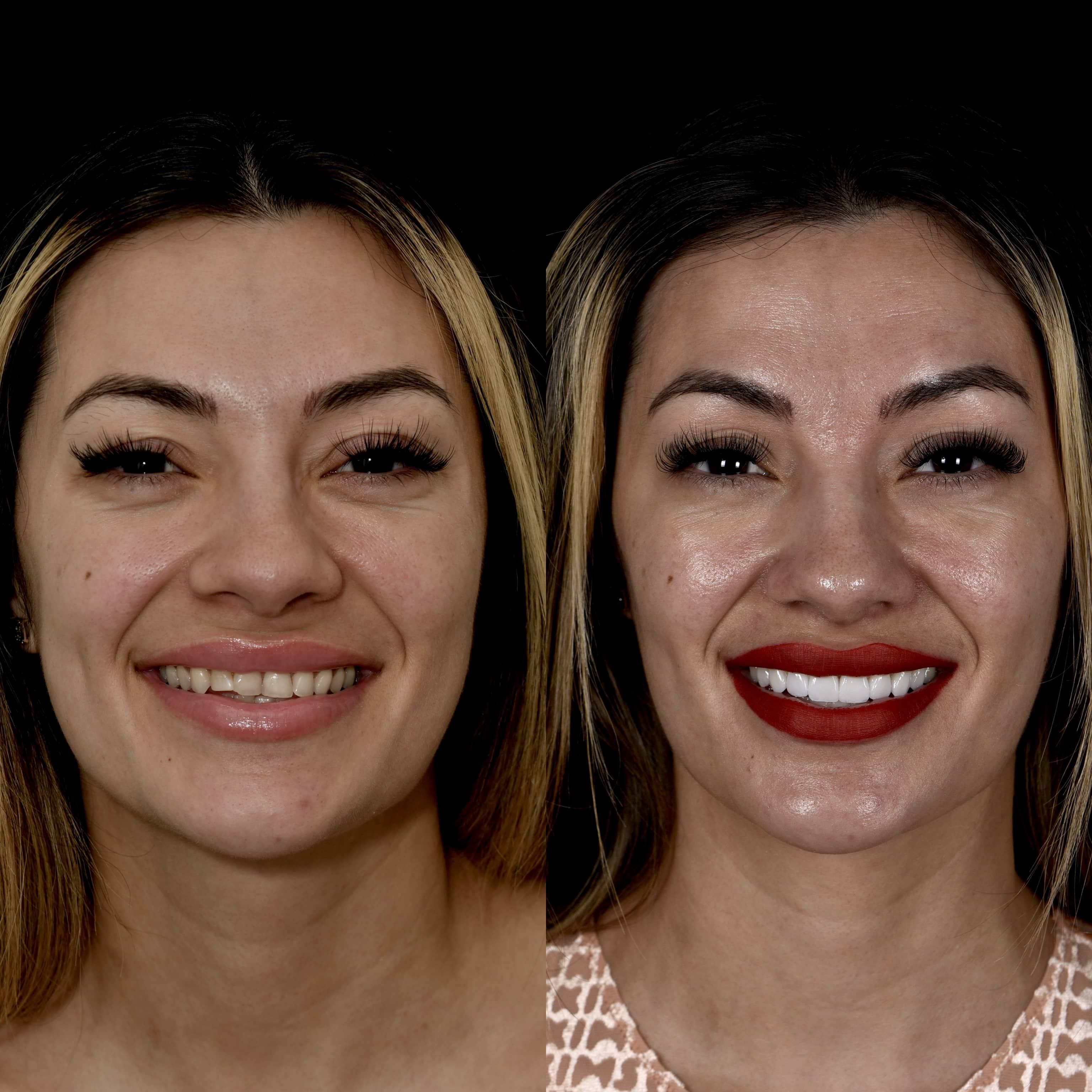 Full face veneers