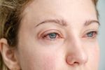What Are the Stages of Glaucoma?