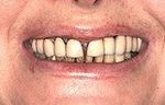before teeth