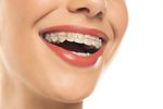Are Ceramic Braces Better Than Regular Braces?