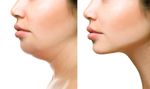 How Does Kybella Work to Reduce a Double Chin?