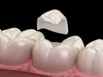 What Are Composite Fillings?
