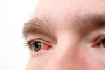 What Are the Symptoms of High Intraocular Pressure?