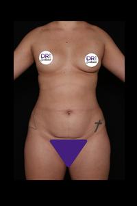 Scottsdale Skinny Before