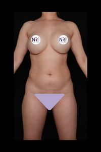 Neck Liposuction Before