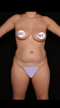 Body Contouring Before