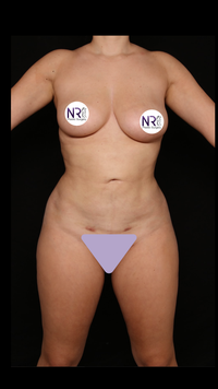 Body Contouring After