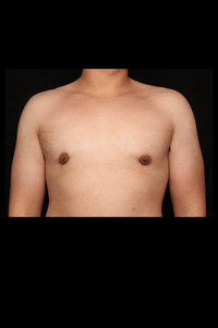 Gynecomastia After