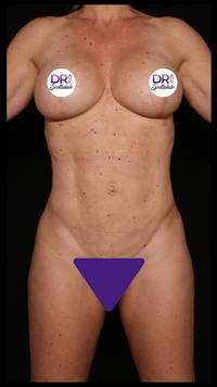 Body Contouring Surgery After