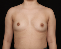Breast Augmentation Before