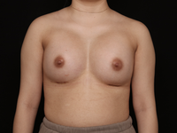 Breast Augmentation After