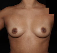 Breast Augmentation Before