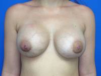 after breast augmentation