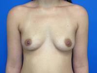 before breast augmentation
