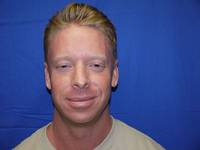 Botox After