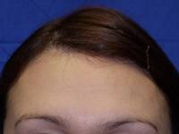Botox After