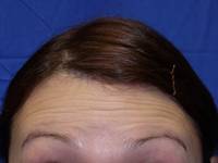 Botox Before