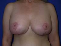 Breast Reduction After