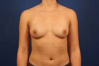 before breast augmentation