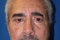 Brow Lift Procedure Photo