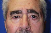 Brow Lift Procedure Photo