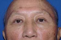 Brow Lift After
