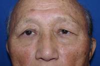 Brow Lift Before