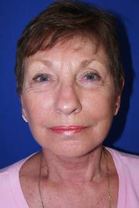 Neck Lift After