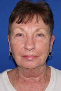 Neck Lift Before