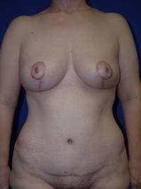 Tummy Tuck After
