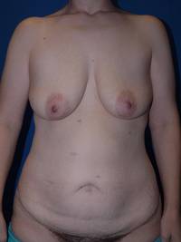 Tummy Tuck Before