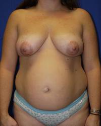 Mommy Makeover Before