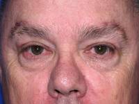 Eyelid Surgery after