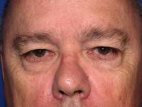 Eyelid Surgery Before