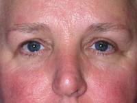 Eyelid Surgery after