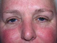 Eyelid Surgery Before