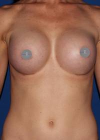 Breast Augmentation after