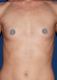 Breast Augmentation Before