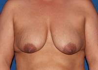 before mastopexy