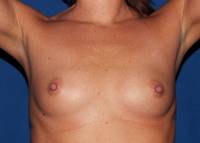 Breast Augmentation Before