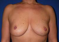 Breast Reduction After