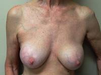 Breast Revision Before