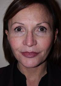 Facelift after