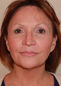 Facelift Before