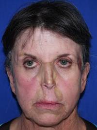 Facelift Before