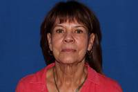 Facelift with Fat Transfer Before