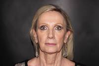 Facelift with Earlobe Repair Before