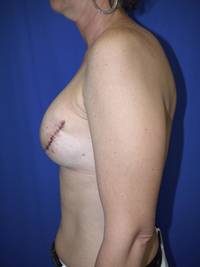 Breast Reconstruction After