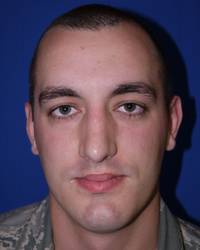 after rhinoplasty